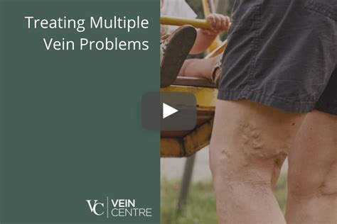 varicose vein treatment mt juliet|Dr. Roger Bonau, MD, FACS .